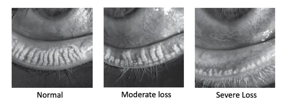 meibomian gland clogged